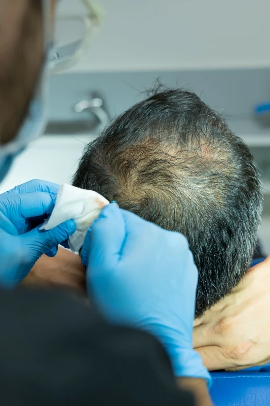 Doctor del centro estetico Kuntur Clinic especialista en tratar con mesoterapia capilar la perdida de cabello masculina en Barcelona