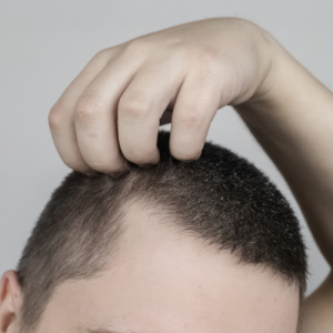 ¿Cuáles son los riesgos del injerto capilar? - nuevo artículo blog de Kuntur Clinic Barcelona
