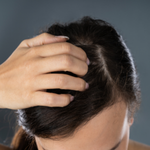 ¿Existe relación entre el picor de cabeza y la caída del cabello_ Te lo contamos en Kuntur Clinic
