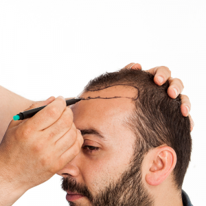 Descubre las fases de un injerto capilar por nuestros especialista de Kuntur Clinic en Barcelona