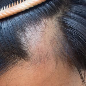 Cómo solucionar la alopecia frontal fibrosante en Kuntur Clinic, clínica capilar de Barcelona