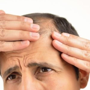 Todo lo que necesitas saber sobre la foliculitis decalvante por Kuntur Clinic en la ciudad de Barcelona