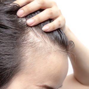Cómo eliminar la alopecia difusa con Kuntur Clinic, clínica capilar de Barcelona