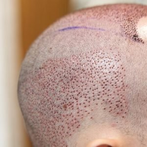 Qué debes hacer tras un injerto capilar con Kuntur Clinic en la ciudad de Barcelona