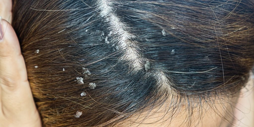 Cómo afecta la dermatitis seborreica al cuero cabelludo por Kuntur Clinic, clínica capilar en Barcelona