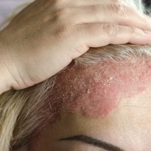 Descubre cómo solucionar la caída de pelo causada por la dermatitis seborreica gracias a Kuntur Clinic, centro capilar de Barcelona