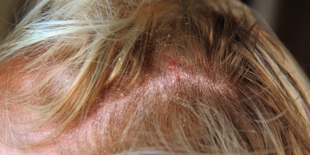 Todo lo que necesitas saber sobre la dermatitis seborreica y la pérdida de pelo con Kuntur Clinic en la localidad de Barcelona