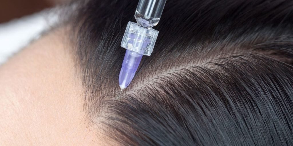 Conoce los secretos de la Mesoterapia con Bioestimulación Autóloga para revitalizar tu cabello en Barcelona