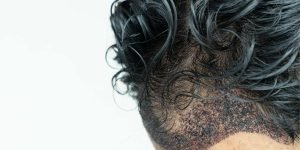 ¿Cuál es la realidad del injerto de pelo_ Descubre los pros y contras en nuestra completa guía