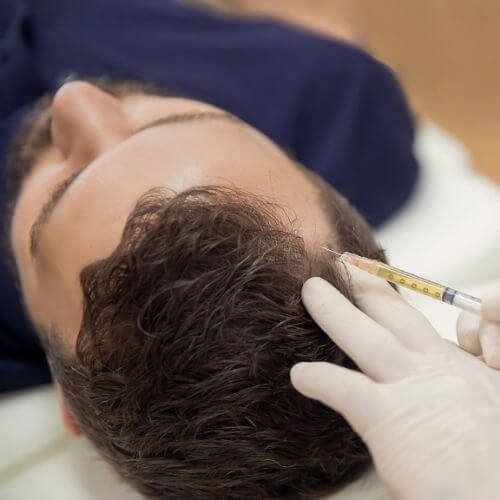 Bioestimuladores: ¿La alternativa al injerto capilar?